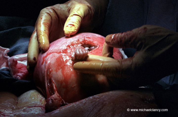 Fetal Surgery: Saving Lives in the Womb